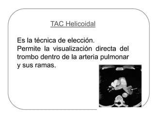 TAC Helicoidal
Es la técnica de elección.
Permite la visualización directa del
trombo dentro de la arteria pulmonar
y sus ramas.
 