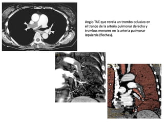 Angio TAC que revela un trombo oclusivo en
el tronco de la arteria pulmonar derecha y
trombos menores en la arteria pulmonar
izquierda (flechas).
 
