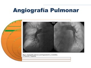 Angiografía Pulmonar
Único que asegura diagnóstico (gold Santandar).
Tiene alta sensibilidad y especificidad en vasos grandes.
A través de la vena femoral se realiza la cateterización por la
aurícula y ventrículo derechos de las arterias pulmonares.
inyectando medio de contraste en la raíz de la arteria pulmonar
Si es negativo habiendo TEP es de mejor pronóstico.
 