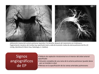 obliteración masiva de la arteria pulmonar izquierda. A la derecha, después del tratamiento con Urokinasa y
fragmentación mecánica del trombo hay reperfusión total y caída de la presión media de arteria pulmonar de 43 a 22
mmHg. (Gentileza Dr Mario Fava, Radiología, U. Católica)
•Defecto de repleción intraluminal en el interior del árbol arterial
opacificado
•Oclusión completa de una rama de la arteria pulmonar (puede darse
por un trombo in situ)
•Retraso en la opacificación de las ramas arteriales pulmonares
Signos
angiográficos
de EP
 