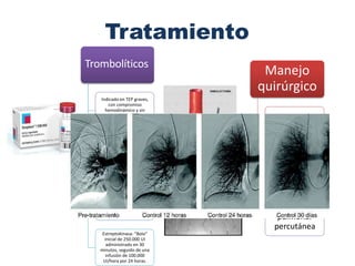 Tratamiento
Trombolíticos
Indicado en TEP graves,
con compromiso
hemodinámico y sin
contraindicaciones para su
uso
Actúan activando el
plasminógeno en plasmina,
que degrada la fibrina de
un trombo en péptidos
solubles.
Complicaciones:
hemorragias cerebrales,
HTA
Estreptokinasa: “Bolo”
inicial de 250.000 UI
administrado en 30
minutos, seguido de una
infusión de 100.000
UI/hora por 24 horas.
Manejo
quirúrgico
Filtro de vena
cava superior
Embolectomía
quirúrgica
Embolectomía
pulmonar
percutánea
 