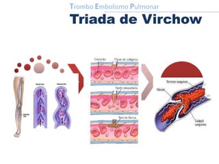 Trombo Embolismo Pulmonar
Triada de Virchow
Estasis.
Provocado por reposo con
ausencia de utilización de
la bomba muscular. Al
circular lentamente la
sangre, finalmente
coagula.
Daño a la pared del vaso.
Ocurre en relación a
trauma del endotelio,
exponiendo las capas
profundas de la pared del
vaso y gatillando la
cascada de la coagulación.
Hipercoagulabilidad.
Yasea congénita o
adquirida.
 