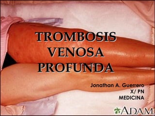 TROMBOSISTROMBOSIS
VENOSAVENOSA
PROFUNDAPROFUNDA
Jonathan A. Guerrero
X/ PN
MEDICINA
 