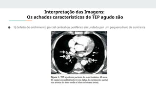 Interpretação das Imagens:
Os achados característicos de TEP agudo são
● 1) defeito de enchimento parcial central ou periférico circundado por um pequeno halo de contraste
 