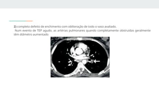 2) completo defeito de enchimento com obliteração de todo o vaso avaliado.
Num evento de TEP agudo, as artérias pulmonares quando completamente obstruídas geralmente
têm diâmetro aumentado
 