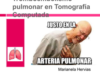 Tromboembolismo
pulmonar en Tomografía
Computada
Marianela Hervias
 
