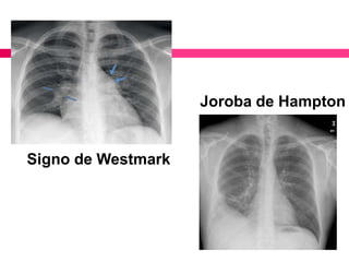 Signo de Westmark
Joroba de Hampton
 