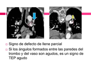  Signo de defecto de llene parcial
 Si los ángulos formados entre las paredes del
trombo y del vaso son agudos, es un signo de
TEP agudo
 