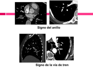 Signo del anillo
Signo de la vía de tren
 