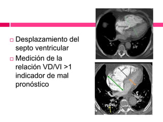  Desplazamiento del
septo ventricular
 Medición de la
relación VD/VI >1
indicador de mal
pronóstico
 