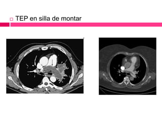  TEP en silla de montar
 