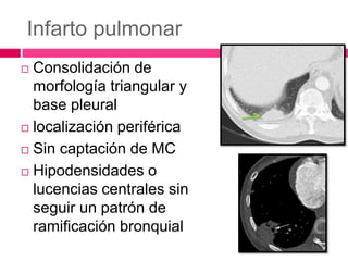 Infarto pulmonar
 Consolidación de
morfología triangular y
base pleural
 localización periférica
 Sin captación de MC
 Hipodensidades o
lucencias centrales sin
seguir un patrón de
ramificación bronquial
 