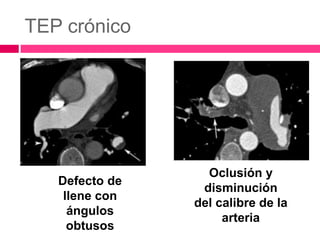 TEP crónico
Defecto de
llene con
ángulos
obtusos
Oclusión y
disminución
del calibre de la
arteria
 