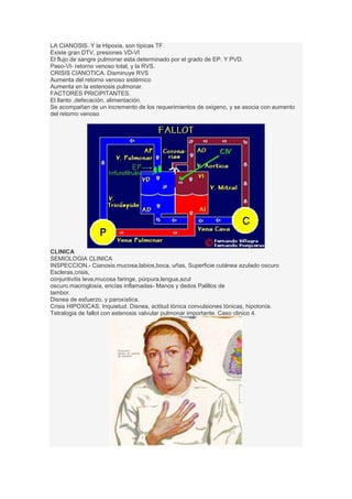 LA CIANOSIS. Y la Hipoxia, son típicas TF.
Existe gran DTV, presiones VD-VI
El flujo de sangre pulmonar esta determinado por el grado de EP. Y PVD.
Paso-VI- retorno venoso total, y la RVS.
CRISIS CIANOTICA. Disminuye RVS
Aumenta del retorno venoso sistémico
Aumenta en la estenosis pulmonar.
FACTORES PRICIPITANTES.
El llanto ,defecación, alimentación.
Se acompañan de un incremento de los requerimientos de oxigeno, y se asocia con aumento
del retorno venoso
CLINICA
SEMIOLOGIA CLINICA
INSPECCION.- Cianosis.mucosa,labios,boca, uñas, Superficie cutánea azulado oscuro
Escleras,crisis,
conjuntivitis leve,mucosa faringe, púrpura,lengua,azul
oscuro.macroglosia, encías inflamadas- Manos y dedos Palillos de
tambor.
Disnea de esfuerzo, y paroxística.
Crisis HIPOXICAS. Inquietud. Disnea, actitud tónica convulsiones tónicas, hipotonía.
Tetralogia de fallot con estenosis valvular pulmonar importante. Caso clinico 4.
 