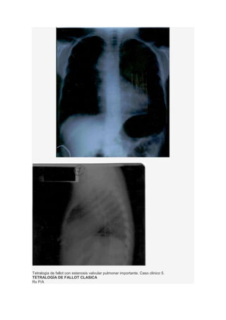 Tetralogia de fallot con estenosis valvular pulmonar importante. Caso clinico 5.
TETRALOGÍA DE FALLOT CLASICA
Rx P/A
 
