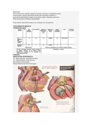 Elevación
de la punta de la silueta cardiaca Corazón de Zueco. Desplazamiento
hacia arriba y afuera del borde ventricular izquierdo.rectilineo o
levemente abombado.imagen de hombre caido. Hipoflujo pulmonar.
PROYECCION LATERAL IZQUIERDA.
Arco inferior del borde anterior en contacto con el esternon.
TRATAMIENTO MEDICO
FARMACOLOGIA
CIRUGIA
INDICACION QUIRURGICA.
TF.-Bien tolerada, aumento de peso.
TF.- Mal tolerada, crisis hipoxia.
Severidad crisis hipoxia
Disponibilidad Servicio Quirúrgico.
 