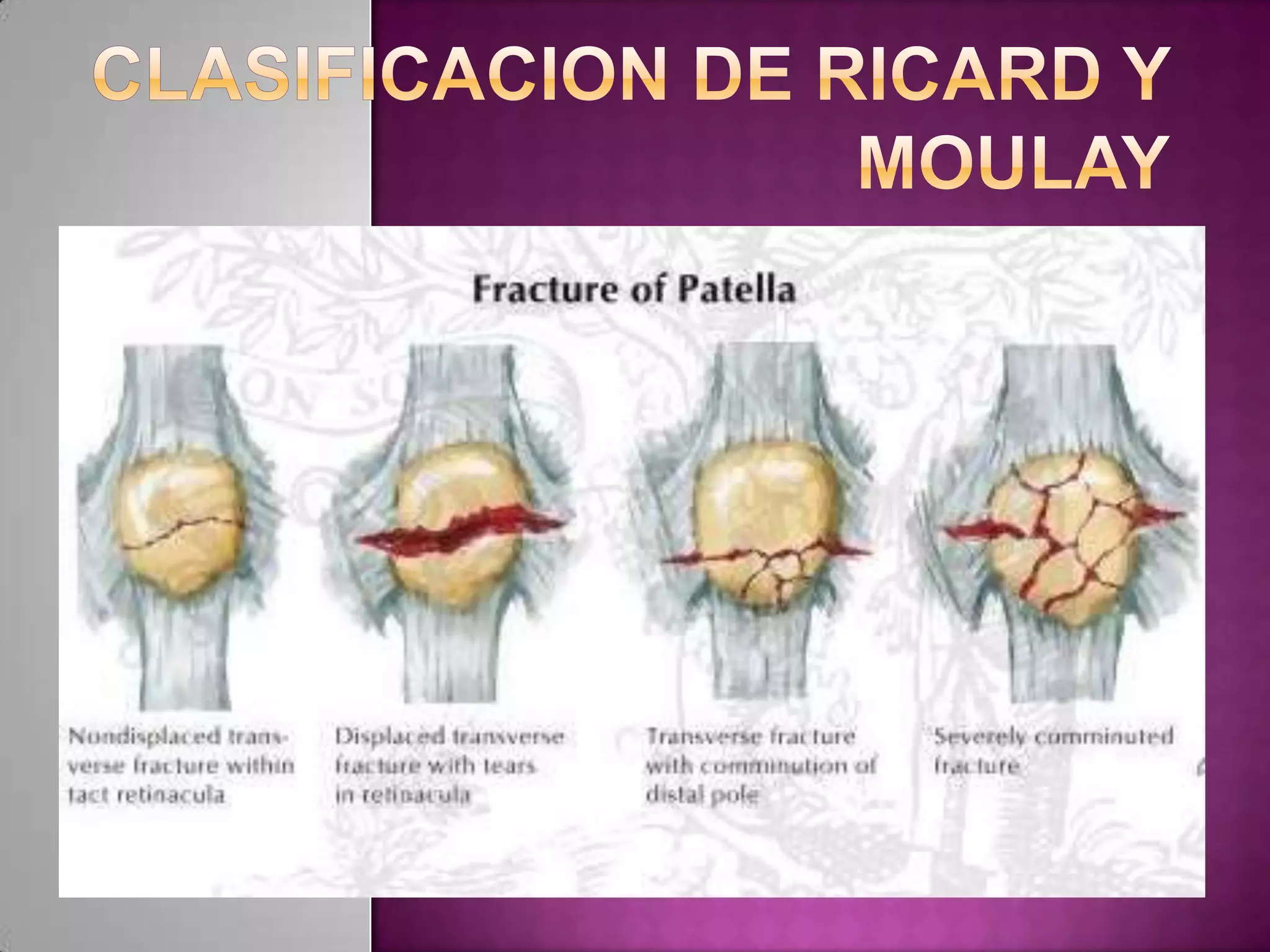 Rotula Matenatica FRACTURA DE ROTULA | PPTX