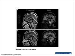Rush S et al. JCO 2013;31:e159-e160

©2013 by American Society of Clinical Oncology

 