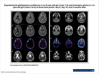 Supratentorial glioblastoma multiforme in an 8-year-old girl (rows 1-4) and brainstem glioma in a 4year-old girl (rows 5 to 8) at three time points: day 0, day 14, and 2 months later.

Gururangan S et al. JCO 2010;28:3069-3075

©2010 by American Society of Clinical Oncology

 