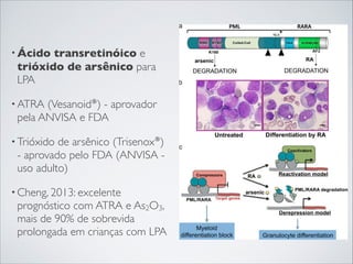 • Ácido

transretinóico e
trióxido de arsênico para
LPA

• ATRA

(Vesanoid®) - aprovador
pela ANVISA e FDA

• Trióxido

de arsênico (Trisenox®)
- aprovado pelo FDA (ANVISA uso adulto)

• Cheng, 2013: excelente

prognóstico com ATRA e As2O3,
mais de 90% de sobrevida
prolongada em crianças com LPA

 