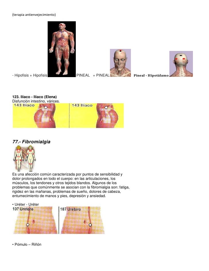 Terapia con imanes Terapia con imanes