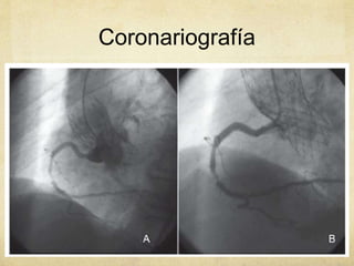 Coronariografía
 
