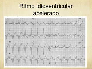 Ritmo idioventricular
acelerado
 