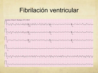 Fibrilación ventricular
 