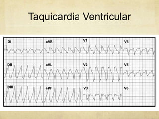 Taquicardia Ventricular
 