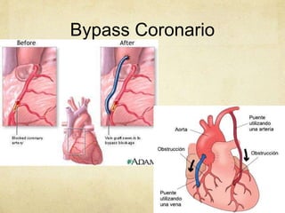 Bypass Coronario
 