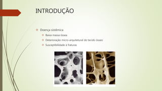 INTRODUÇÃO
 Doença sistêmica
 Baixa massa óssea
 Deterioração micro-arquitetural do tecido ósseo
 Susceptibilidade à fraturas
 