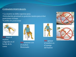 Terapia fisica y rehabilitacion en amputados Slide 18