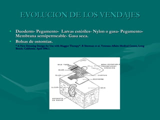 EVOLUCION DE LOS VENDAJES Duoderm- Pegamento-  Larvas estériles- Nylon o gasa- Pegamento- Membrana semipermeable- Gasa seca. Bolsas de ostomías. “  A New Dressing Design for Use with Maggot Therapy”. R Sherman et al. Veterans Affairs Medical Center, Long Beach. California. April 1996.1. 