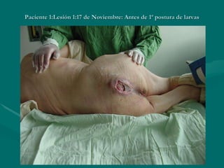 Paciente 1:Lesión 1:17 de Noviembre: Antes de 1ª postura de larvas 