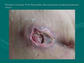 Paciente 1: Lesion1 :17 de Noviembre: Sin tratamiento, fondo parcialmente reseco 