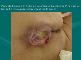 Paciente 1: Lesión 1 : 3 días de tratamiento: Después de 1ª postura de larvas. Se retiro quirúrgicamente el fondo reseco 