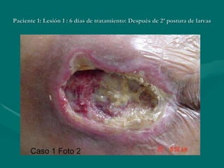 Paciente 1: Lesión 1 : 6 días de tratamiento: Después de 2ª postura de larvas 