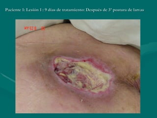 Paciente 1: Lesión 1 : 9 días de tratamiento: Después de 3ª postura de larvas 
