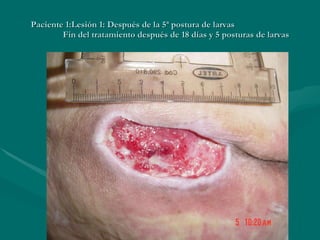 Paciente 1:Lesión 1: Después de la 5ª postura de larvas Fin del tratamiento después de 18 días y 5 posturas de larvas 