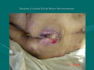 Paciente 2: Lesión 2:11 de Marzo: Sin tratamiento 