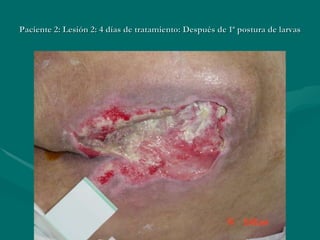 Paciente 2: Lesión 2: 4 días de tratamiento: Después de 1ª postura de larvas 