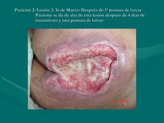 Paciente 2: Lesión 2: 16 de Marzo: Después de 1ª postura de larvas   Paciente se da de alta de esta lesión después de 4 días de    tratamiento y una postura de larvas 