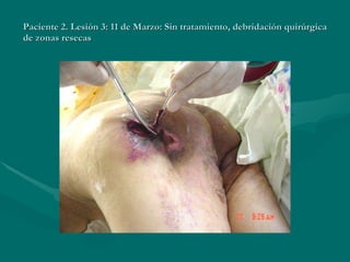 Paciente 2. Lesión 3: 11 de Marzo: Sin tratamiento, debridación quirúrgica de zonas resecas 