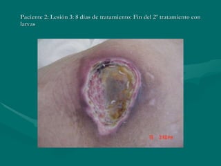 Paciente 2: Lesión 3: 8 días de tratamiento: Fin del 2º tratamiento con larvas  
