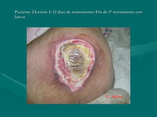 Paciente 2:Lesión 3: 12 días de tratamiento: Fin de 3º tratamiento con larvas 