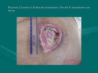 Paciente 2: Lesión 3: 16 días de tratamiento : Fin del 4º tratamiento con larvas 