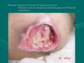 Paciente 2: Lesión 3: Fin de la 5ª postura de larvas   Paciente se da de alta de esta lesión después de 19 días de    tratamiento 