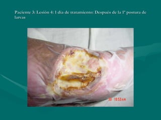 Paciente 3: Lesión 4: 1 día de tratamiento: Después de la 1ª postura de larvas 