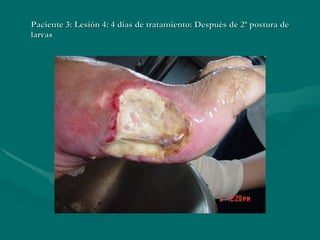 Paciente 3: Lesión 4: 4 días de tratamiento: Después de 2ª postura de larvas 
