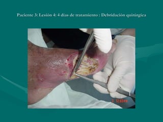 Paciente 3: Lesión 4: 4 días de tratamiento : Debridación quirúrgica 